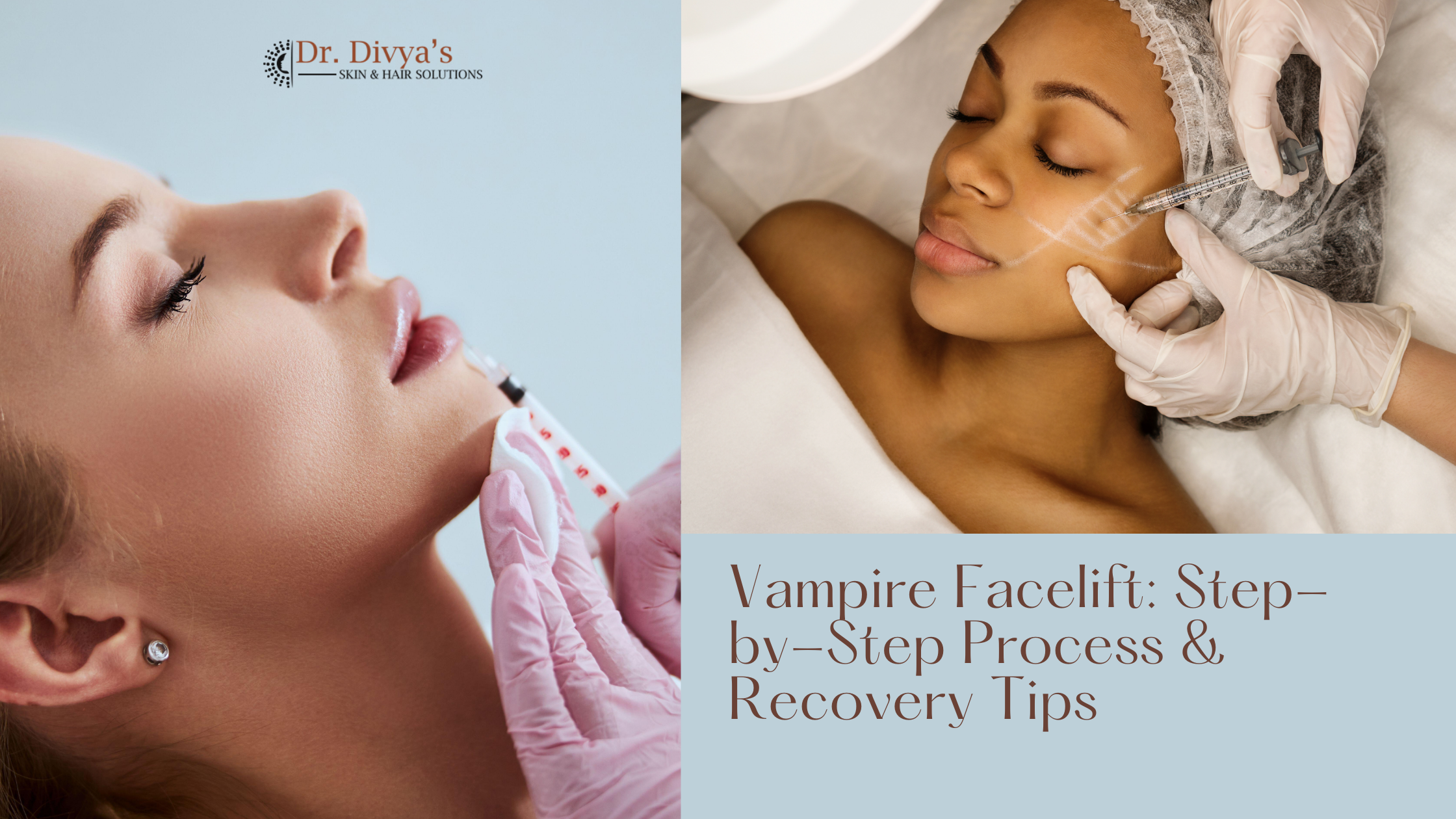 Vampire Facelift