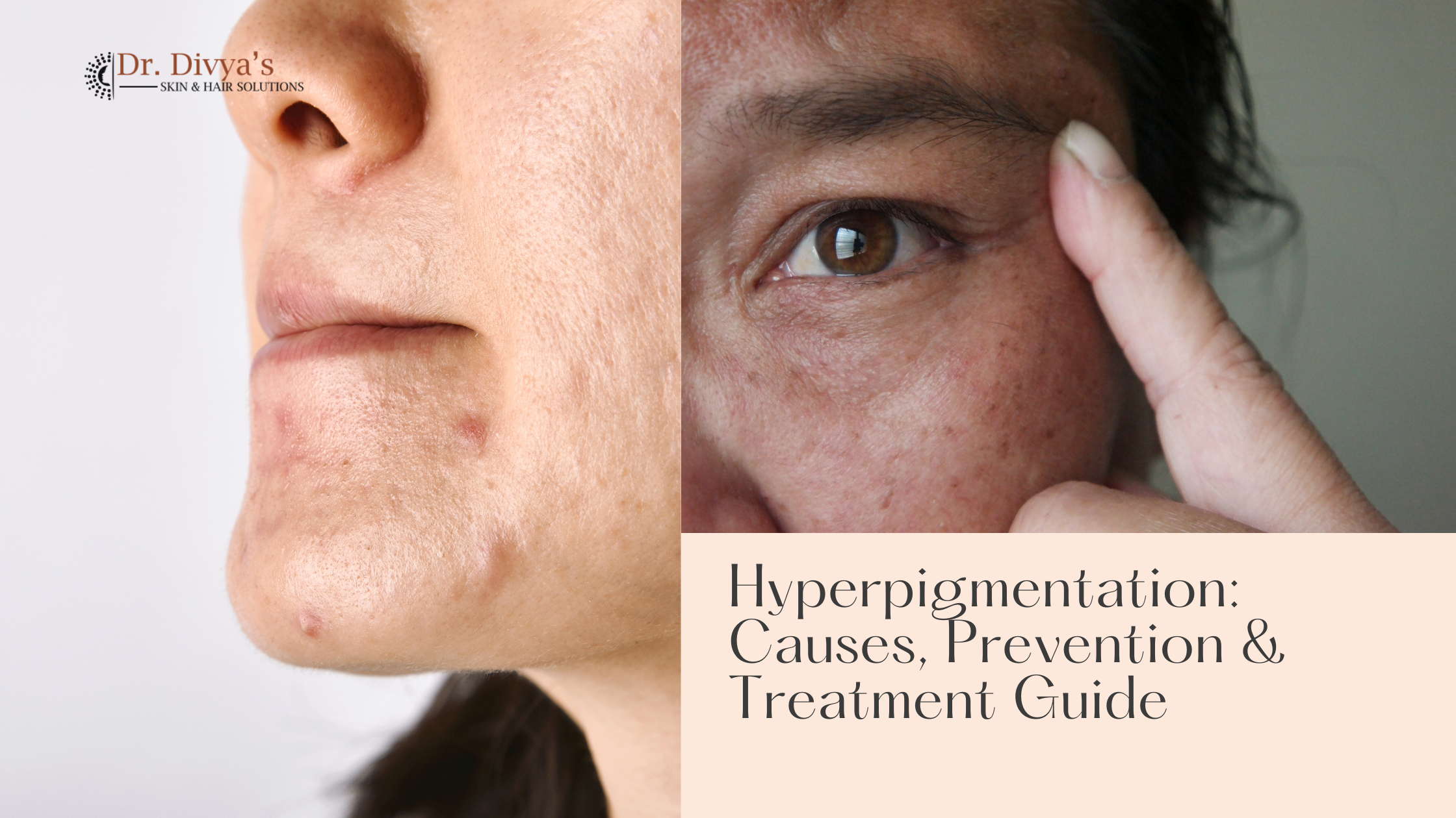 Causes and treatment of hyperpigmentation