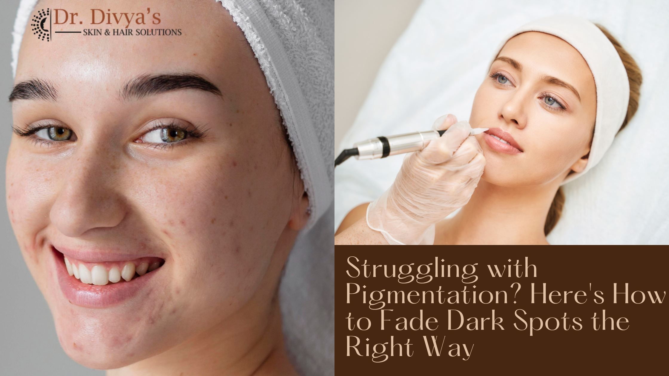 Struggling with Pigmentation