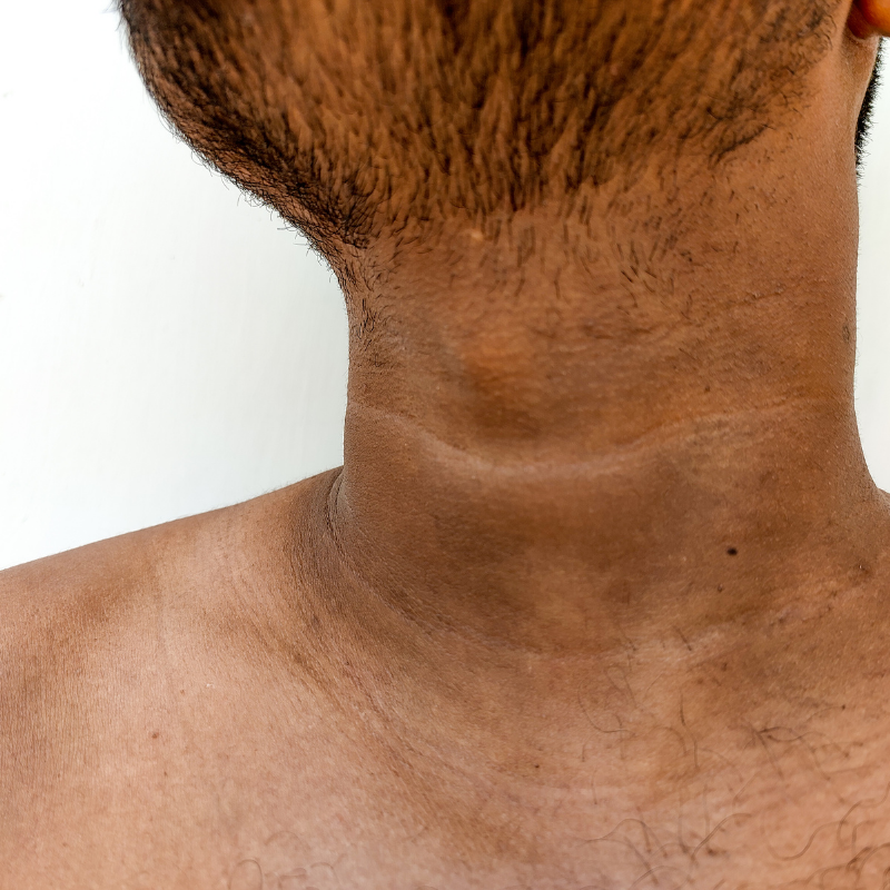 What is the treatment for dark skin on neck?