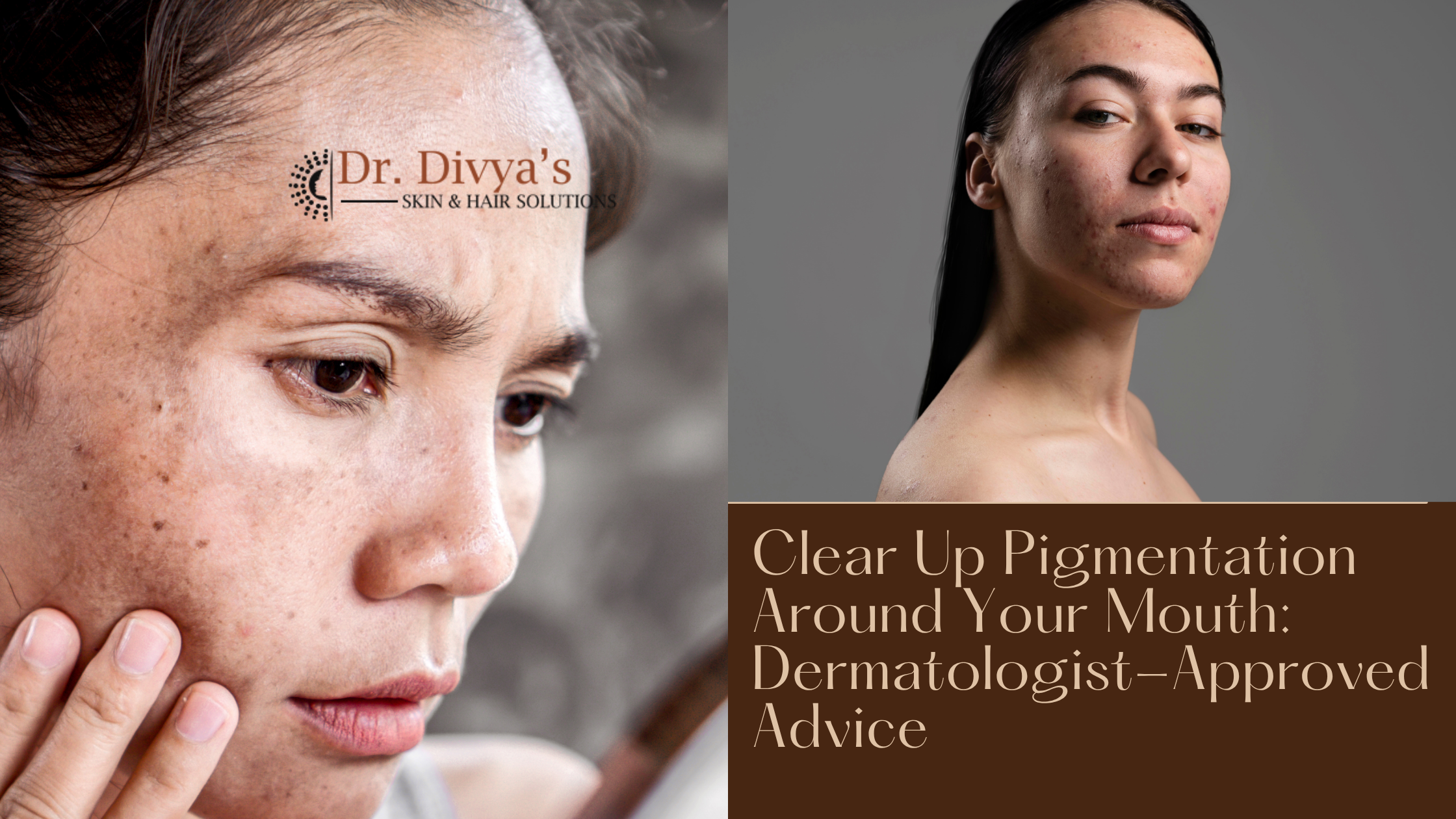  Pigmentation Around Your Mouth