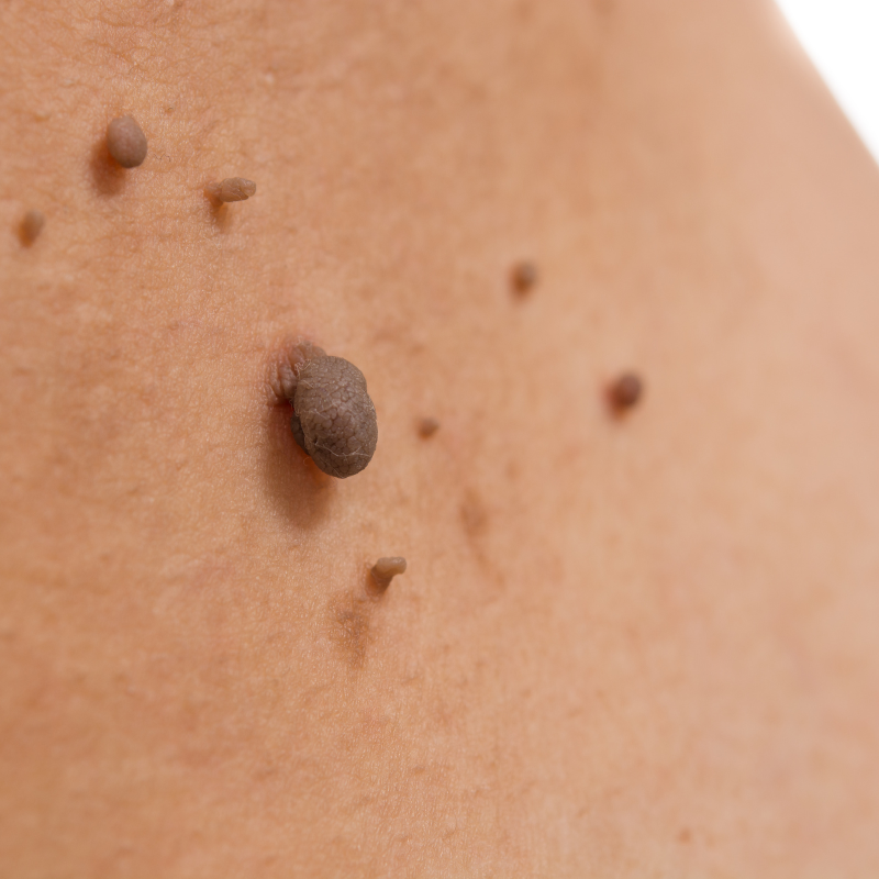 Dermatologist for Mole Removal