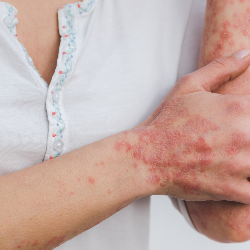 What is lichen planus?