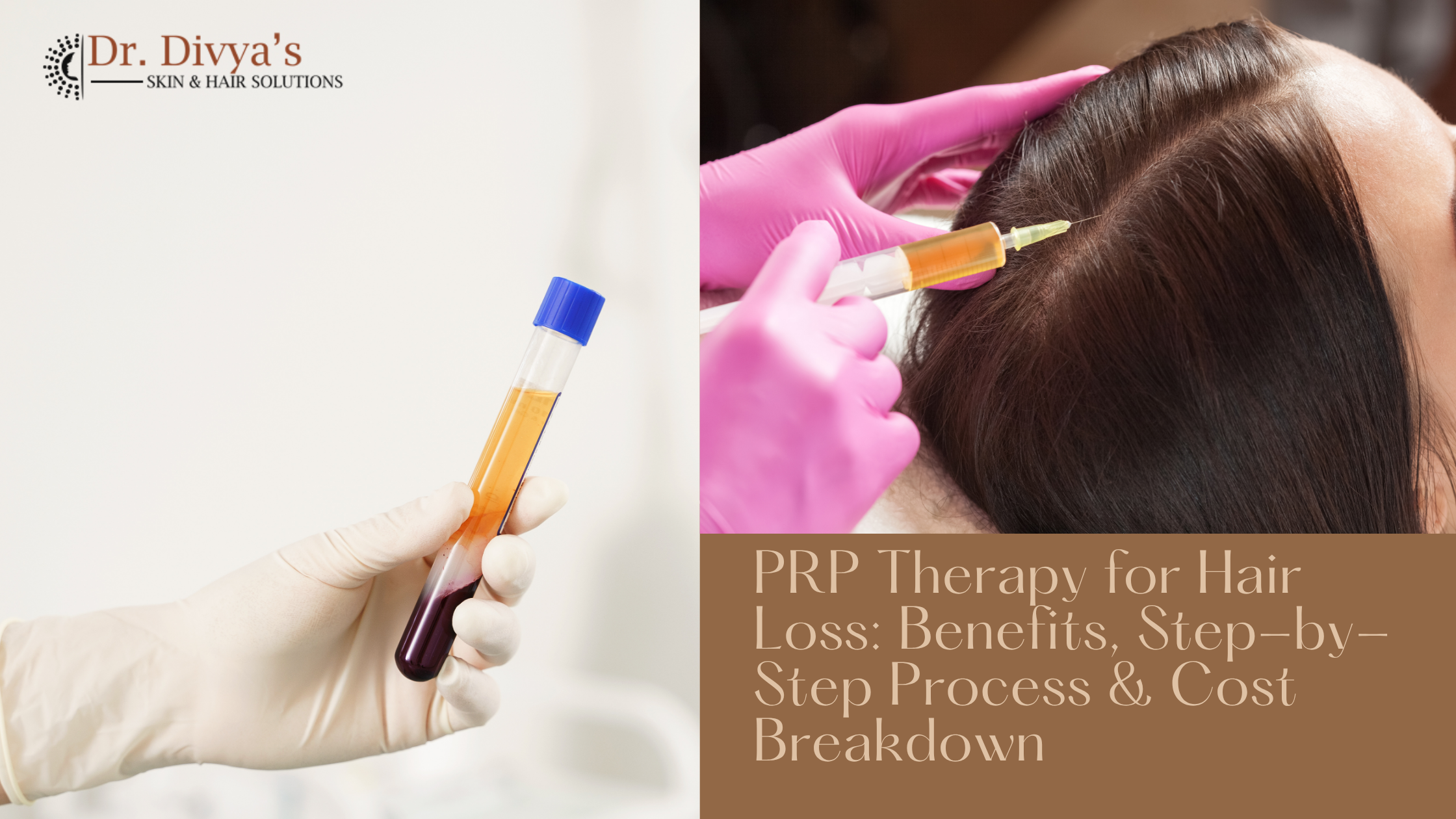 PRP Therapy for Hair Loss 