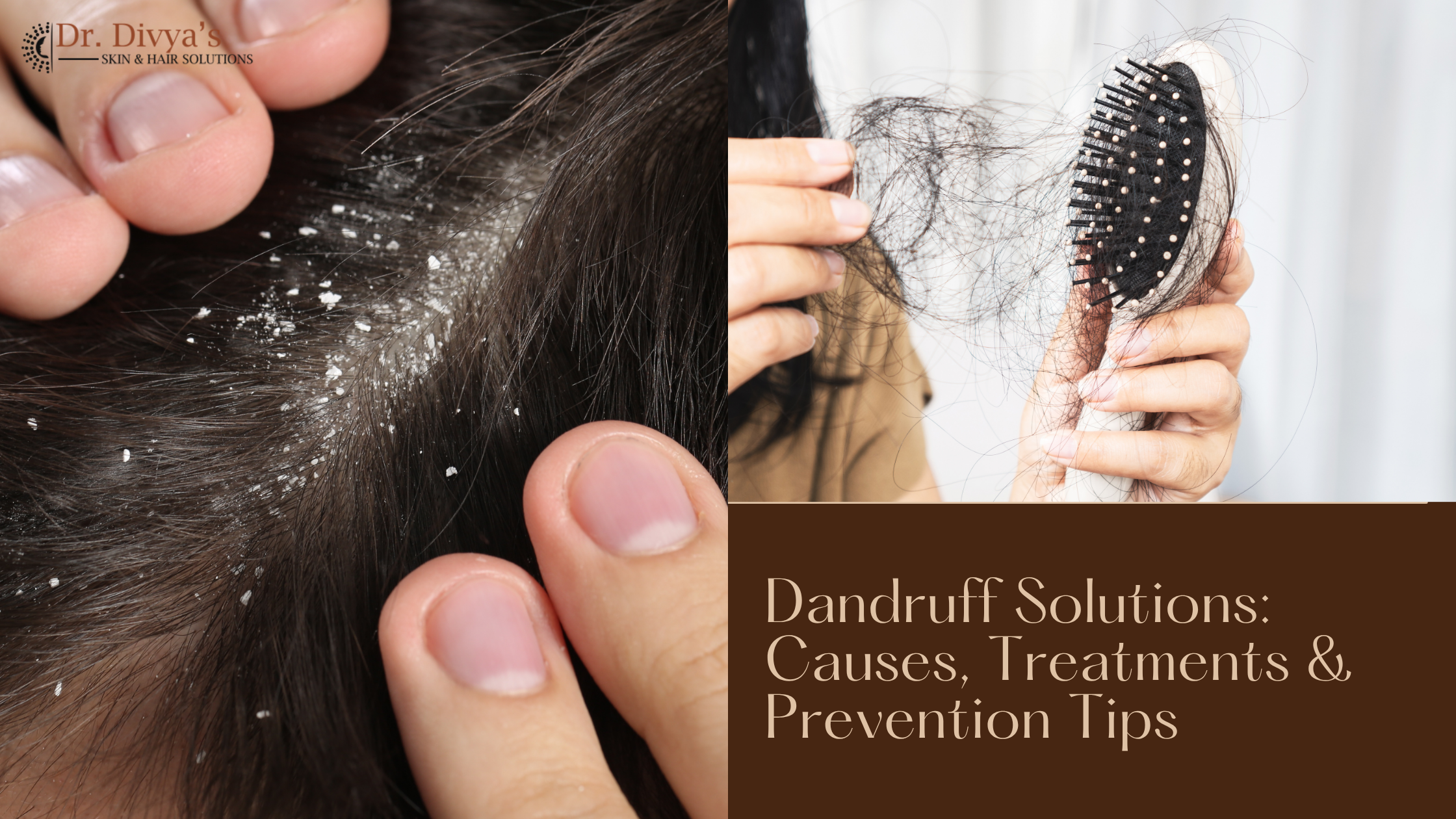 Dandruff Solutions Causes Treatments 