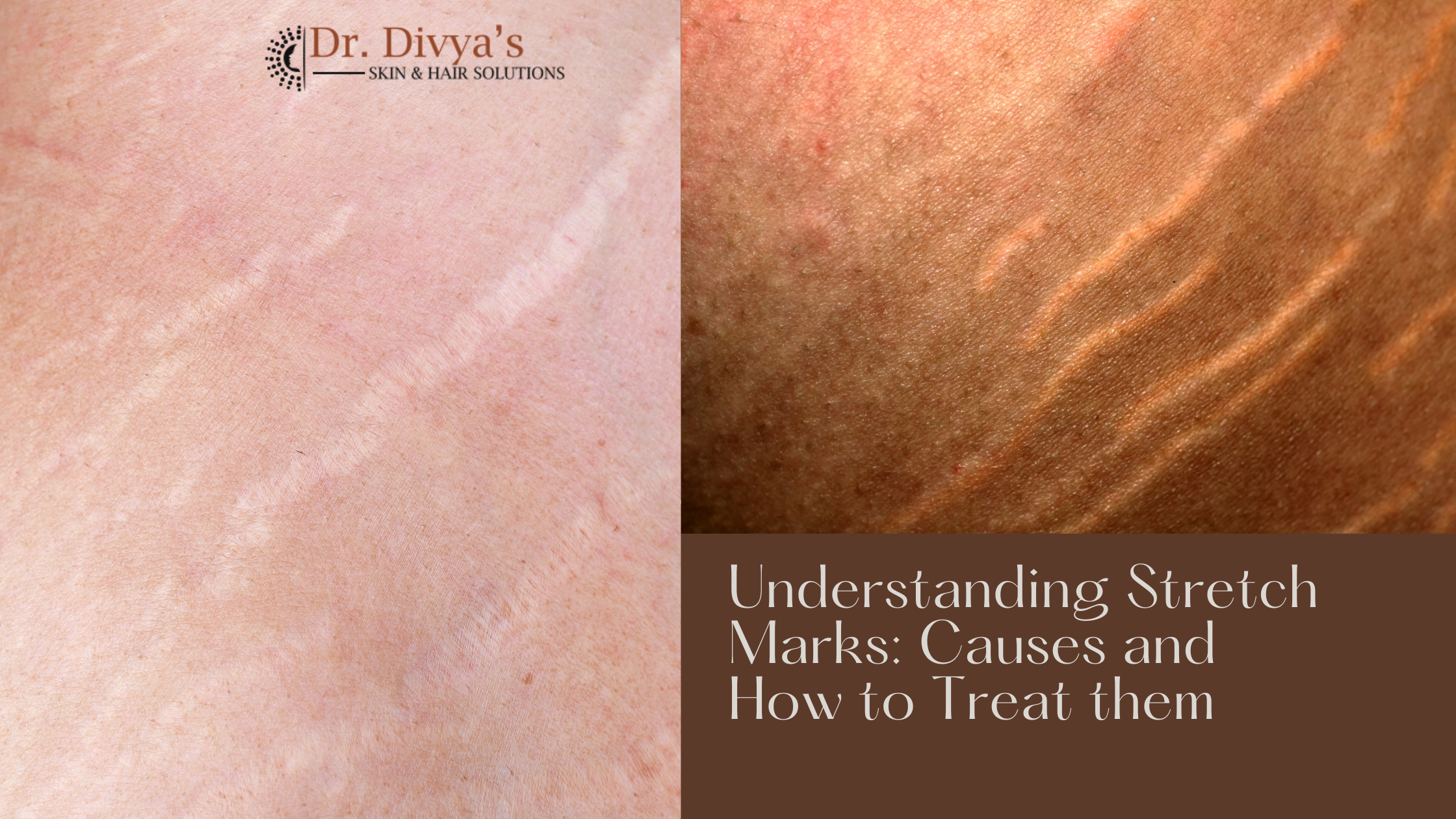 Causes Stretch Marks