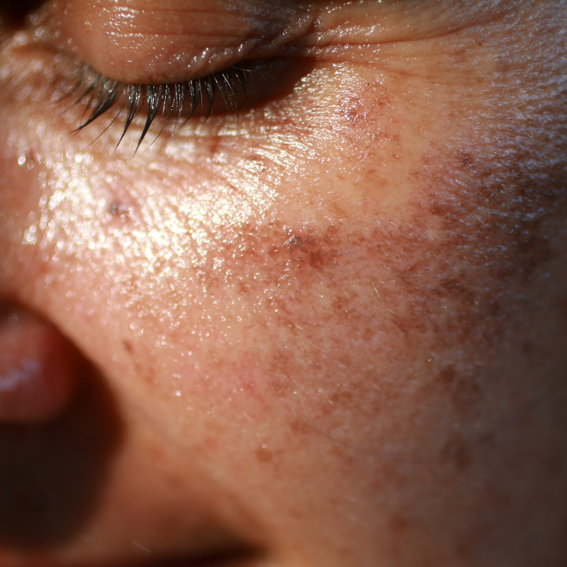 hyperpigmentation treatment and prevention