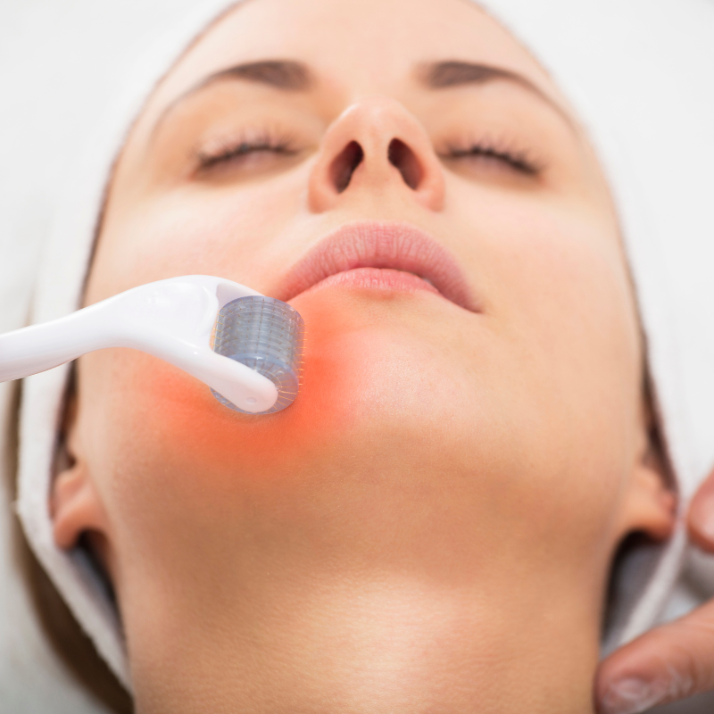 What is Microneedling