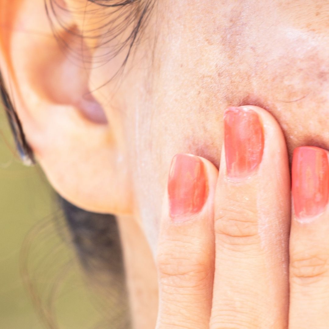 Best treatments of pigmentation