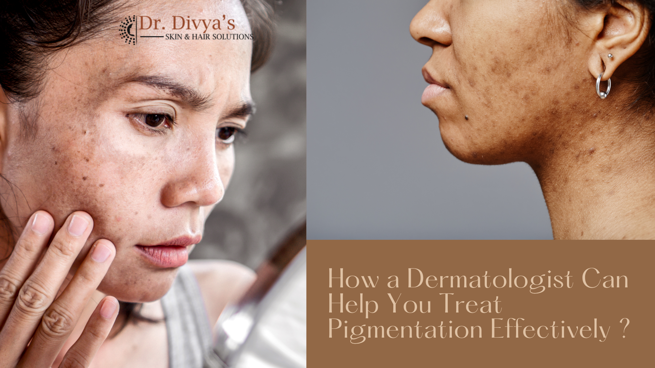 Treat Pigmentation Effectively