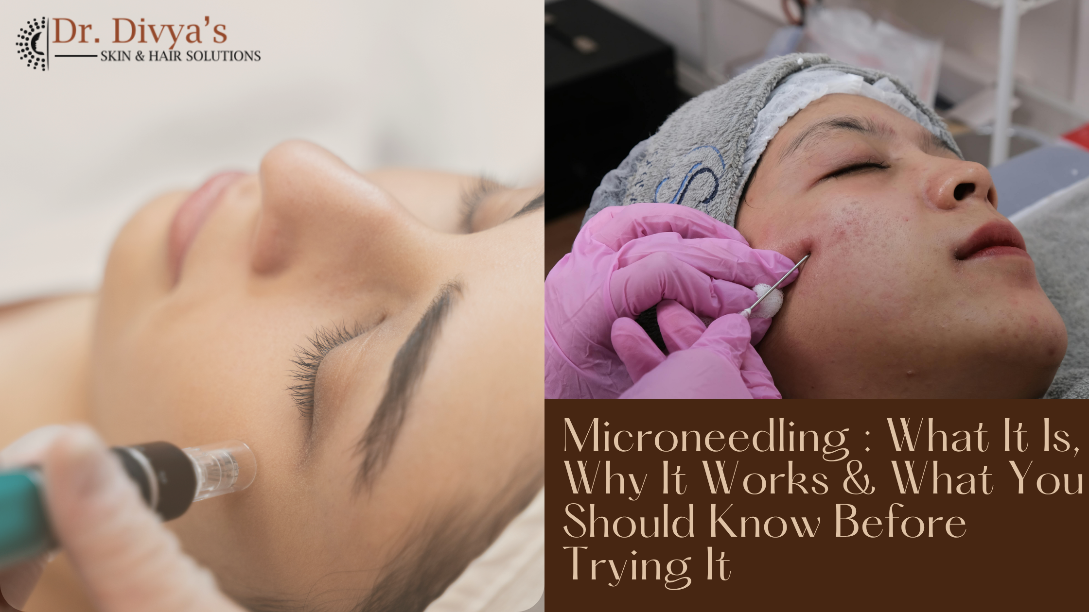 Microneedling