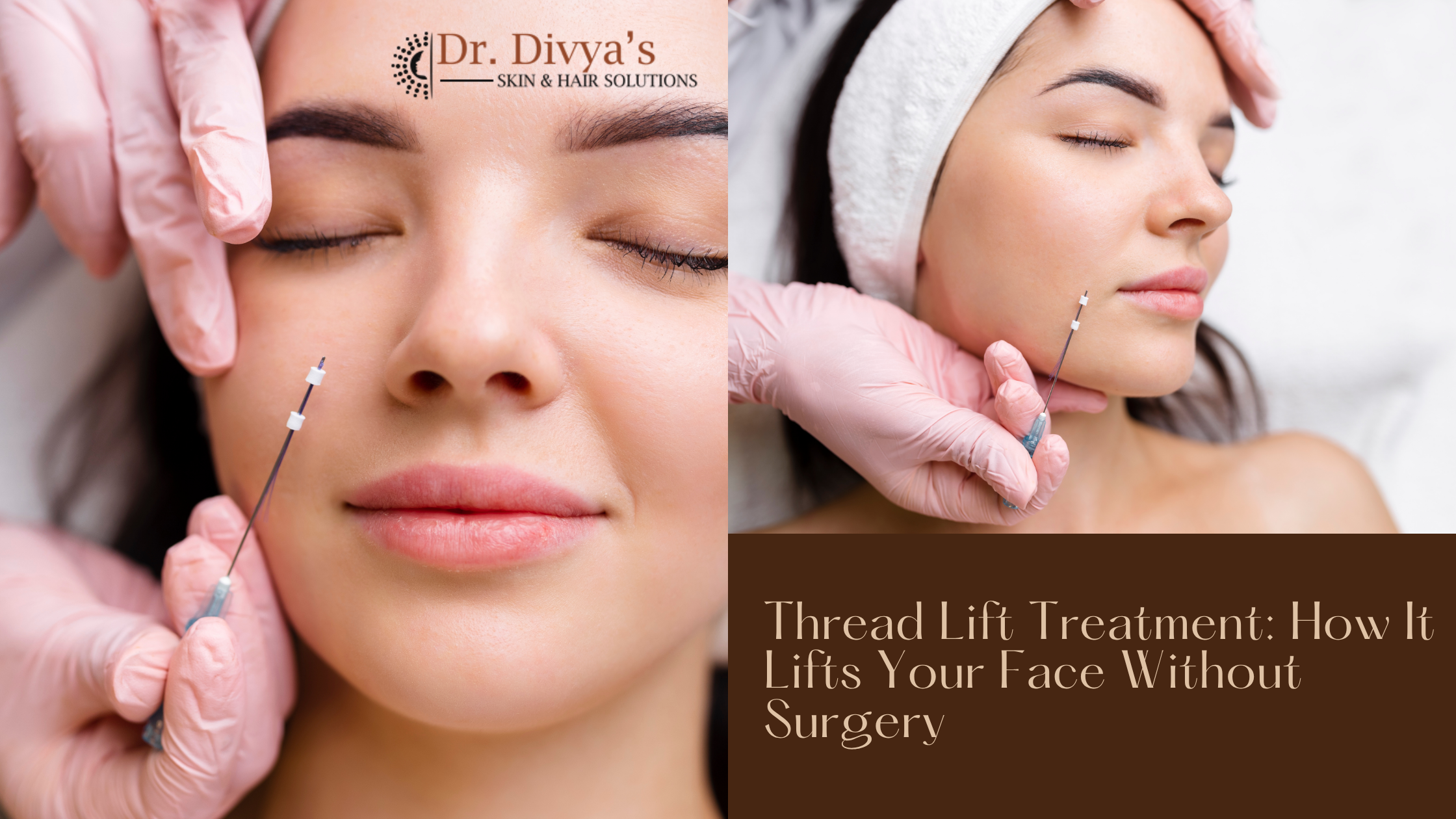 Thread Lift Treatment