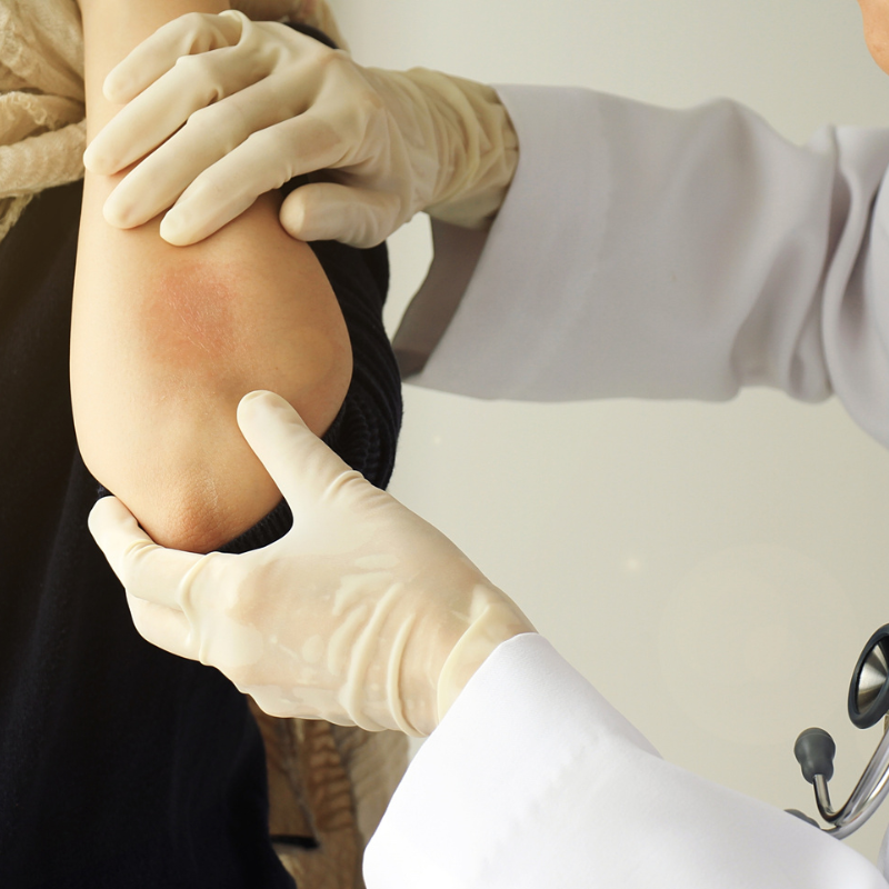 Rash Treatment in Bangalore