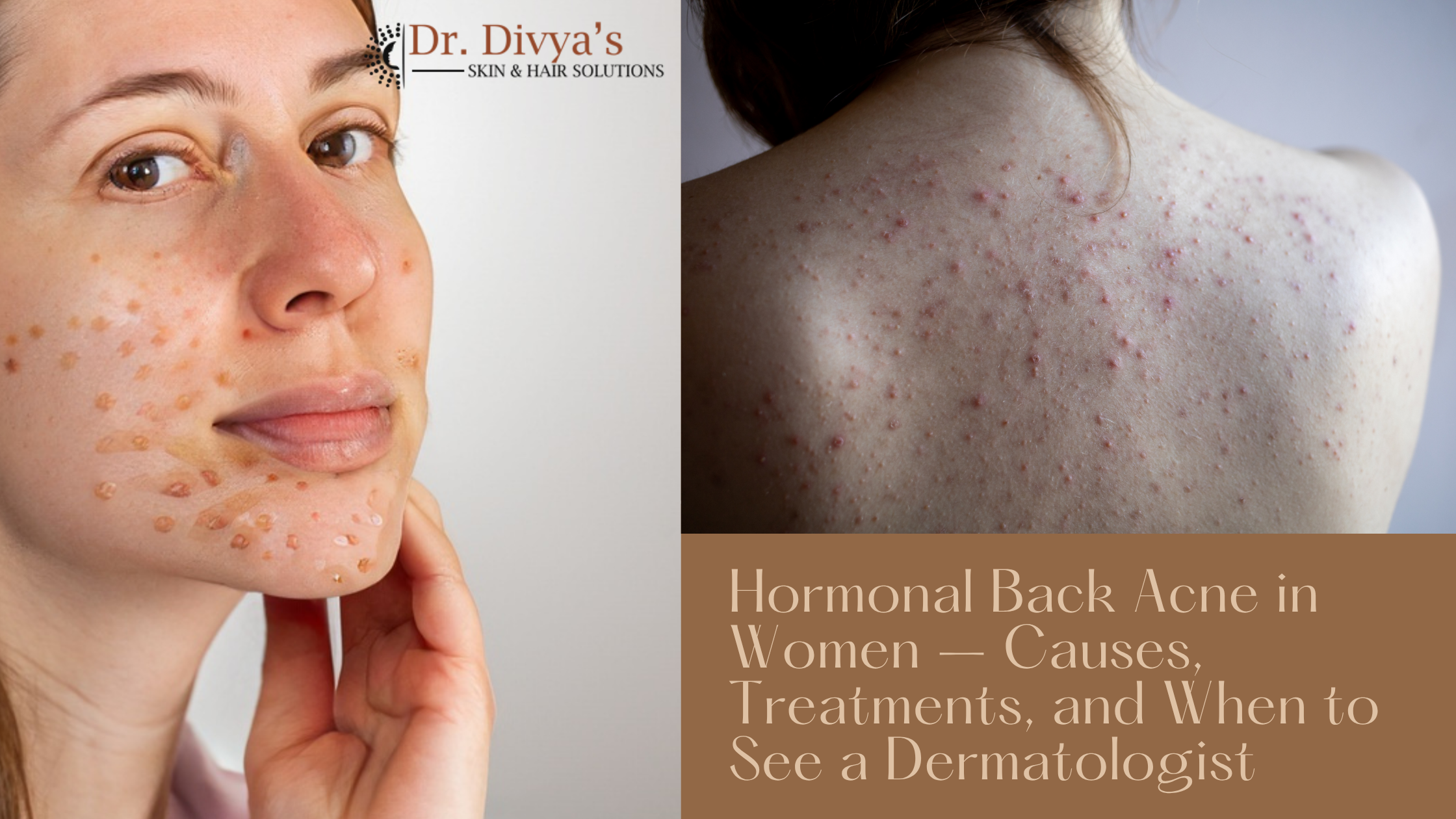 Hormonal Back Acne in Women