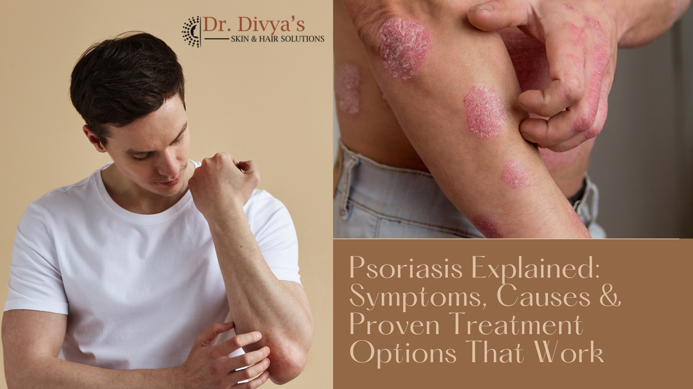 Common Signs and Symptoms of Psoriasis