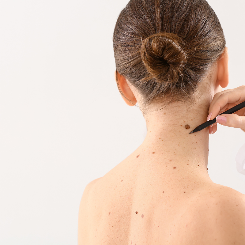 Is mole removal possible?