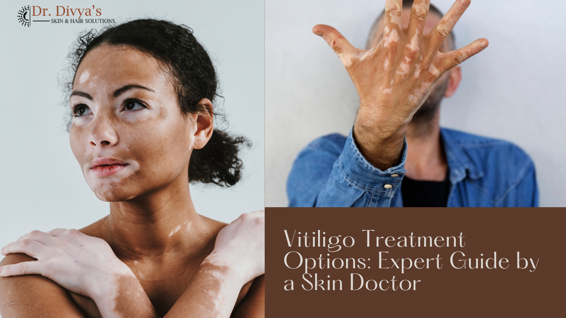 Vitiligo Treatment Options