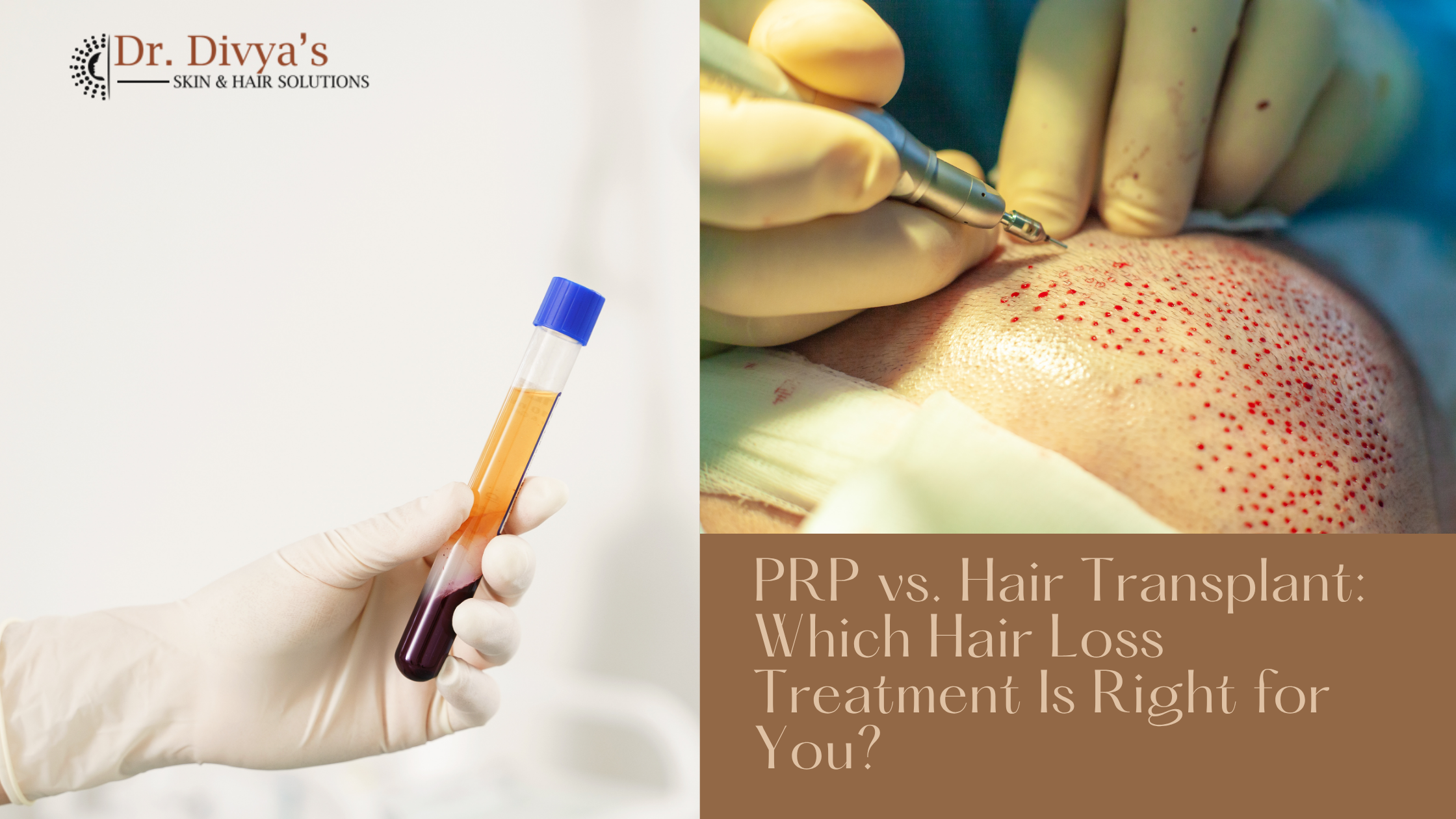 PRP vs. Hair Transplant