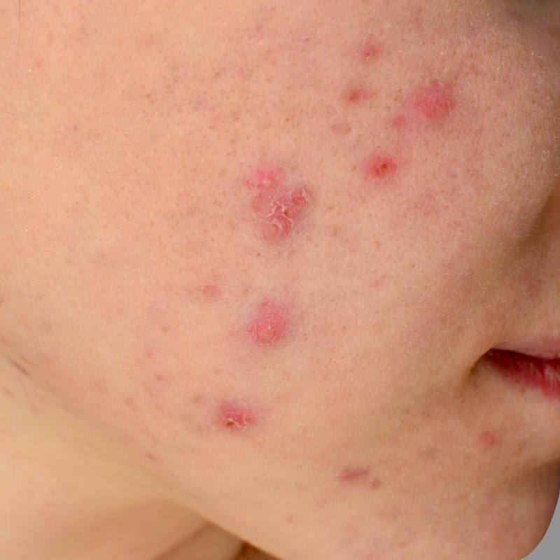 Acne Scar Treatment in Bangalore