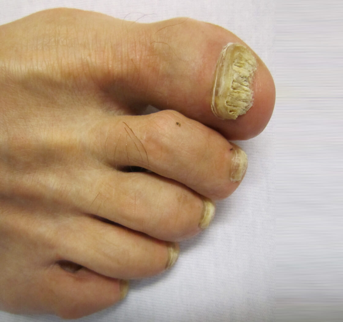 Learn About Fungal Toenail Infections