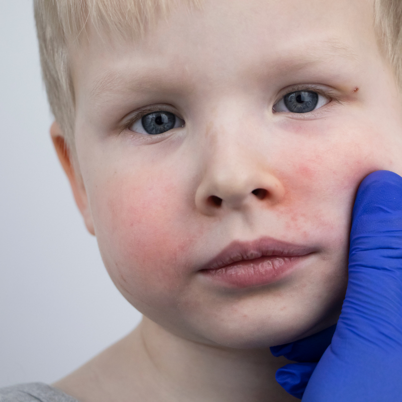What  causes eczema in kids?