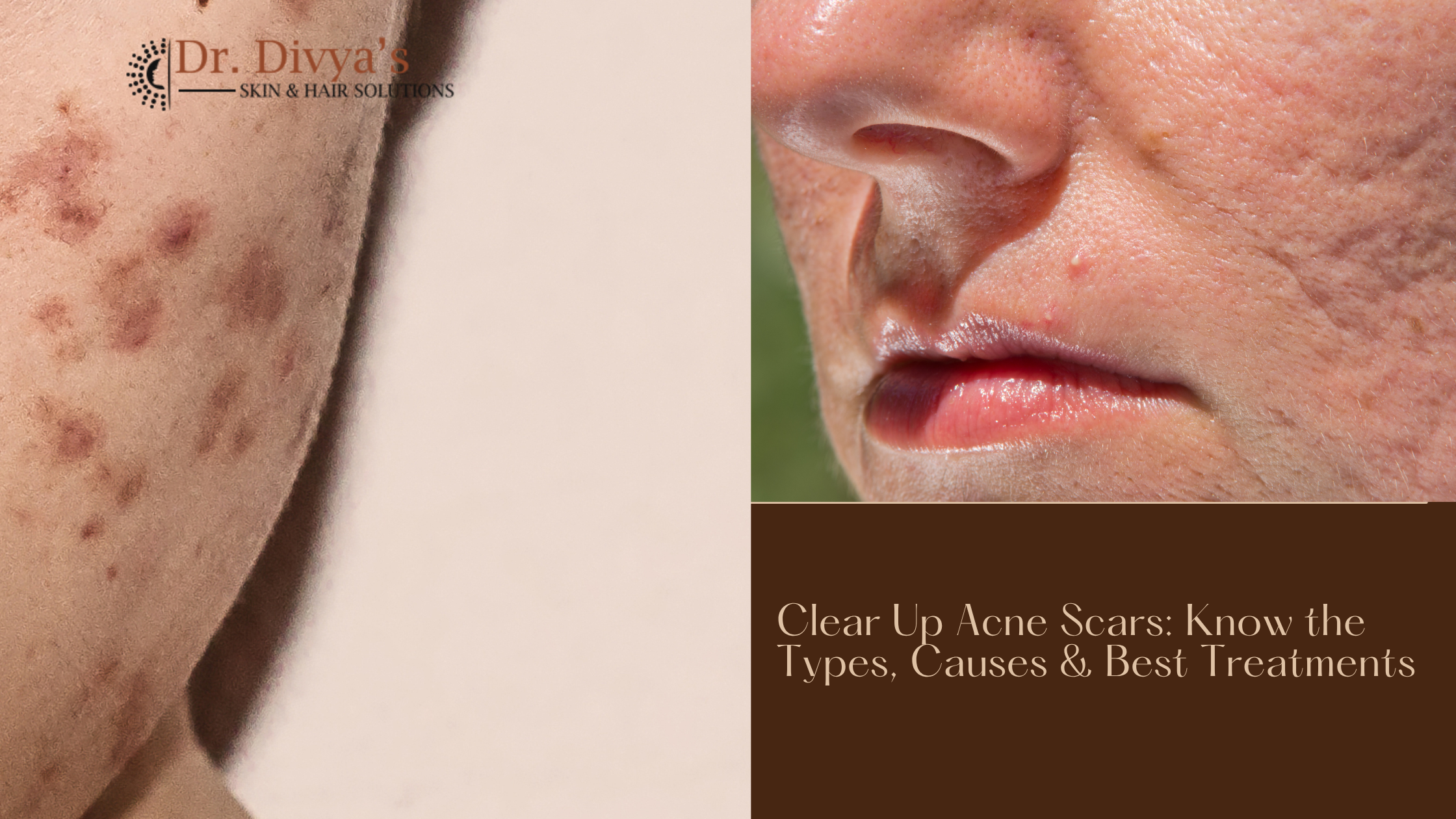 Types Causes and Best Treatments for Acne Scars