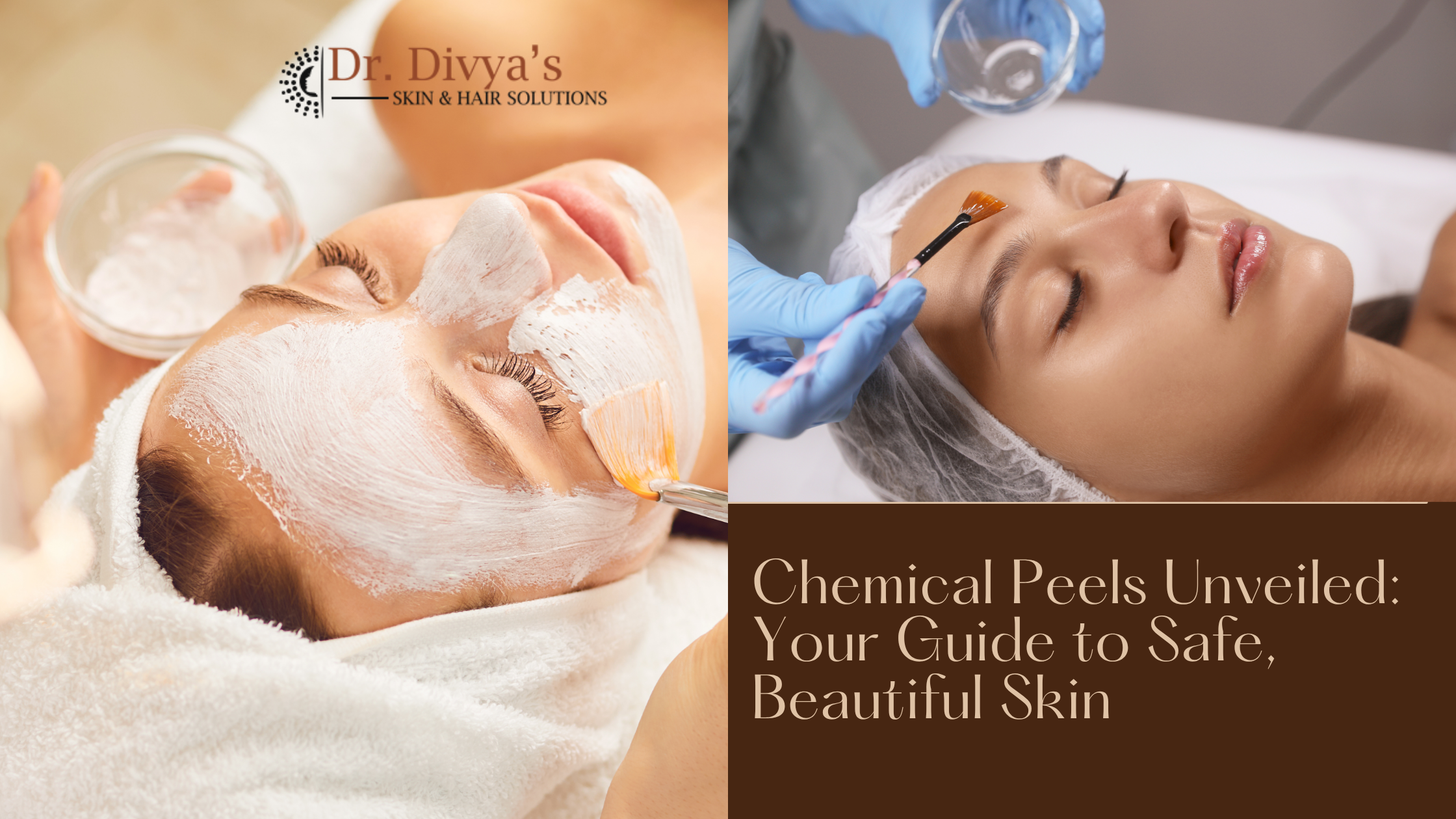 Chemical Peels