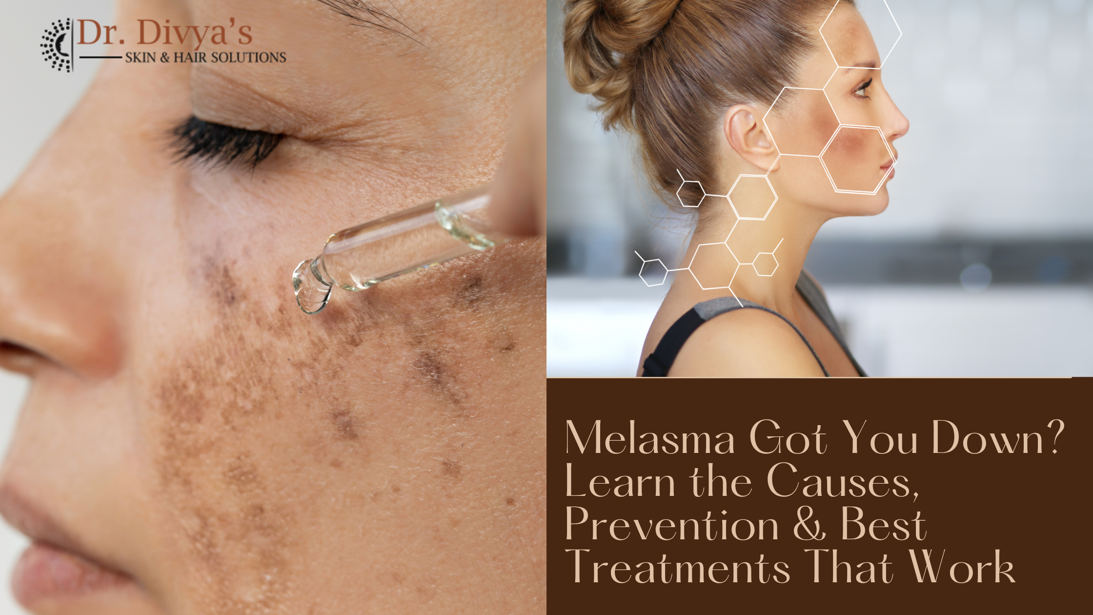 MelasmaPrevention