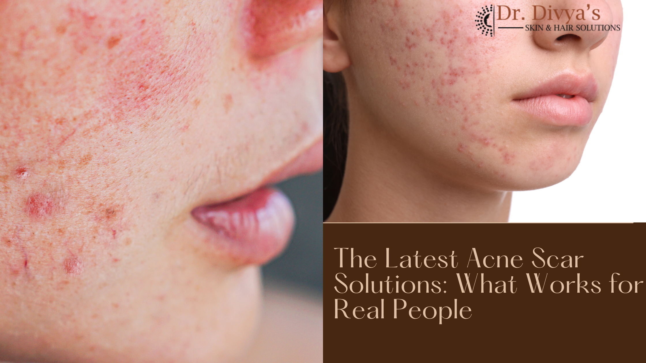 Acne Scar Solutions