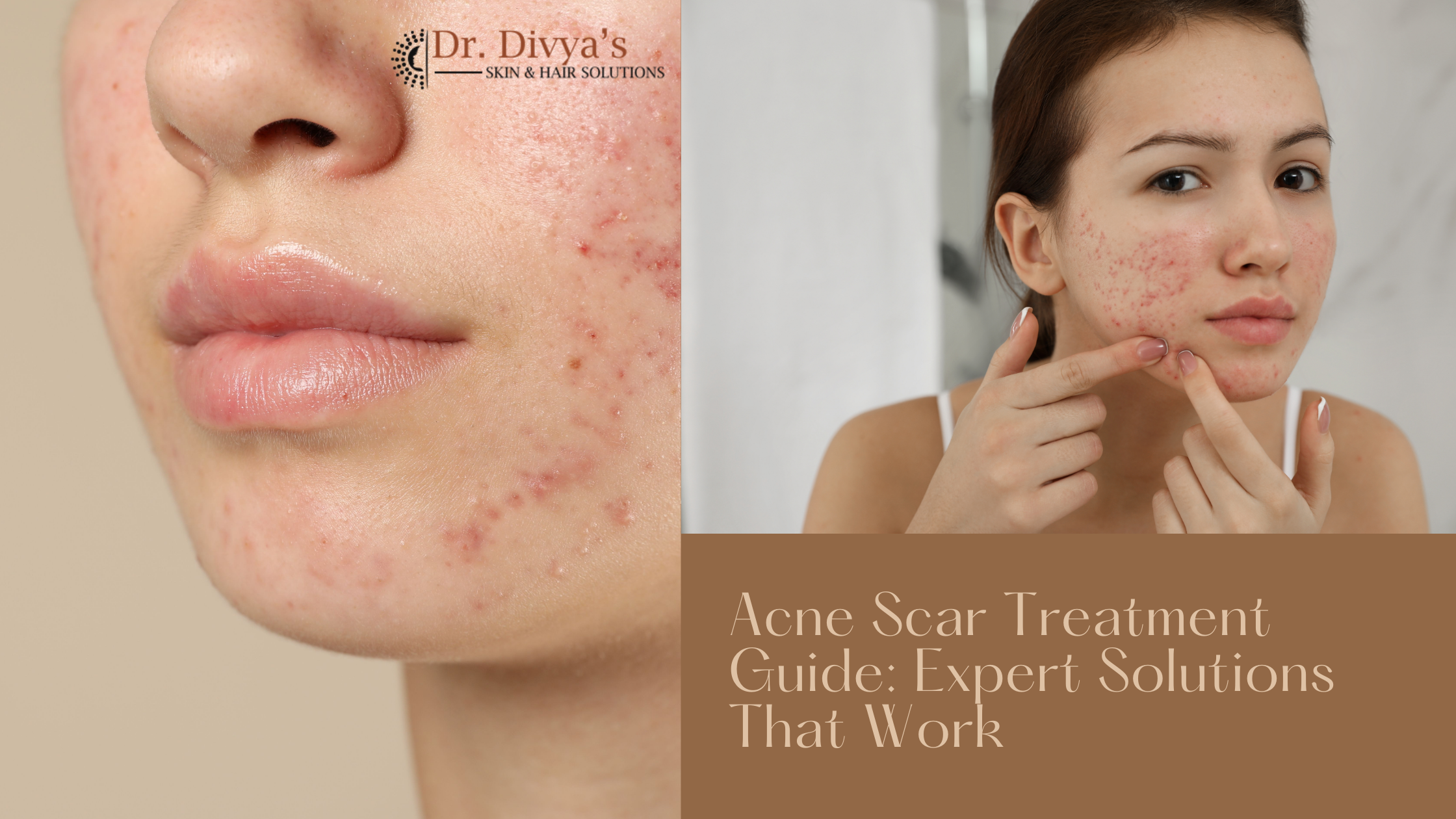 Acne Scar Treatment in bangalore