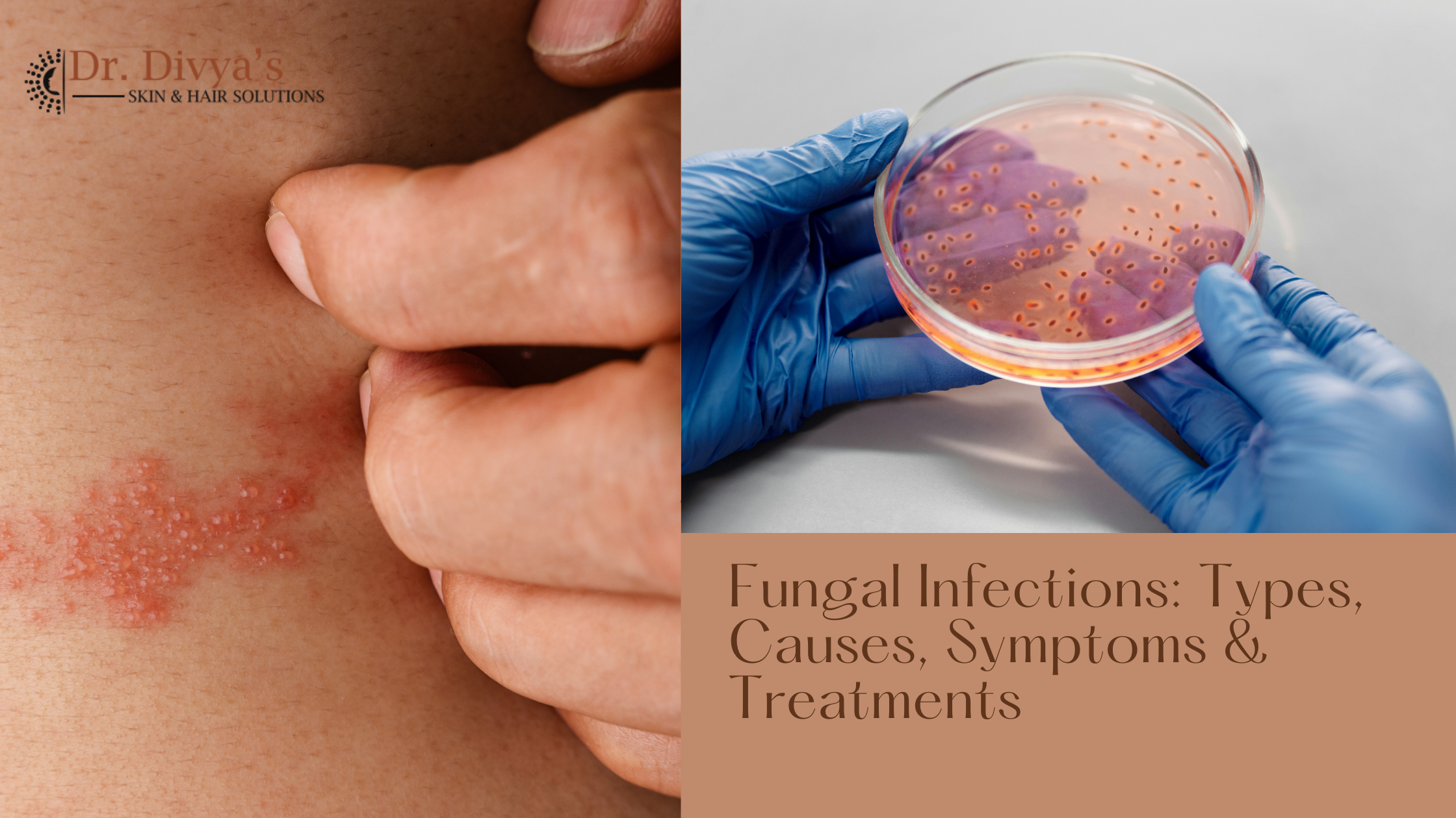 Symptoms and Treatments of Fungal Infections