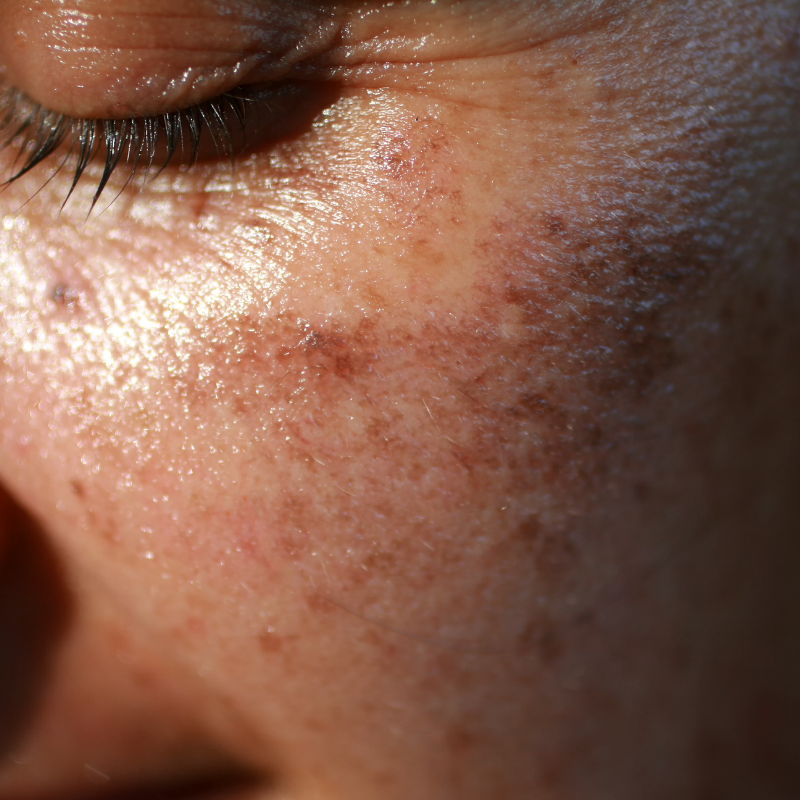 Dark spots after pimples