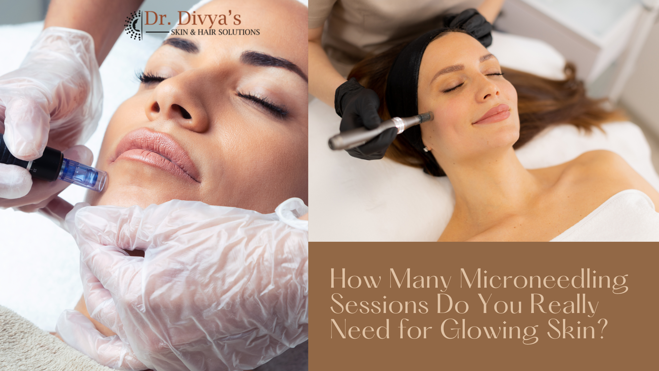 Microneedling Sessions for glowing skin