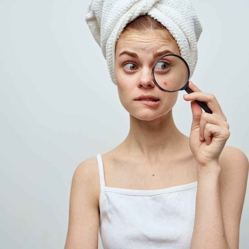 What to do with acne that refuses to go?
