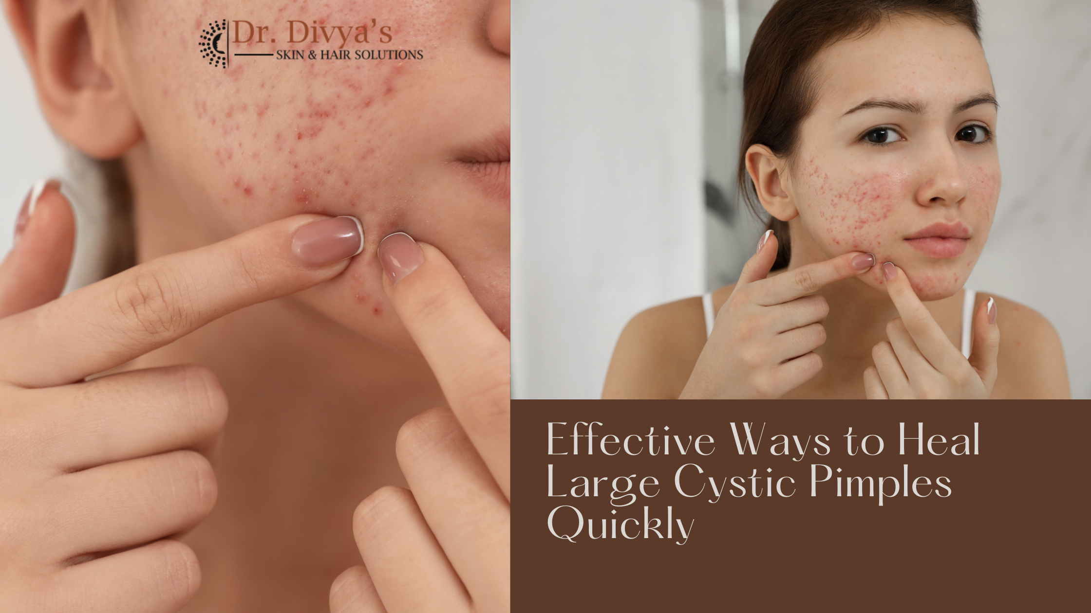 Ways to Heal Large Cystic Pimples