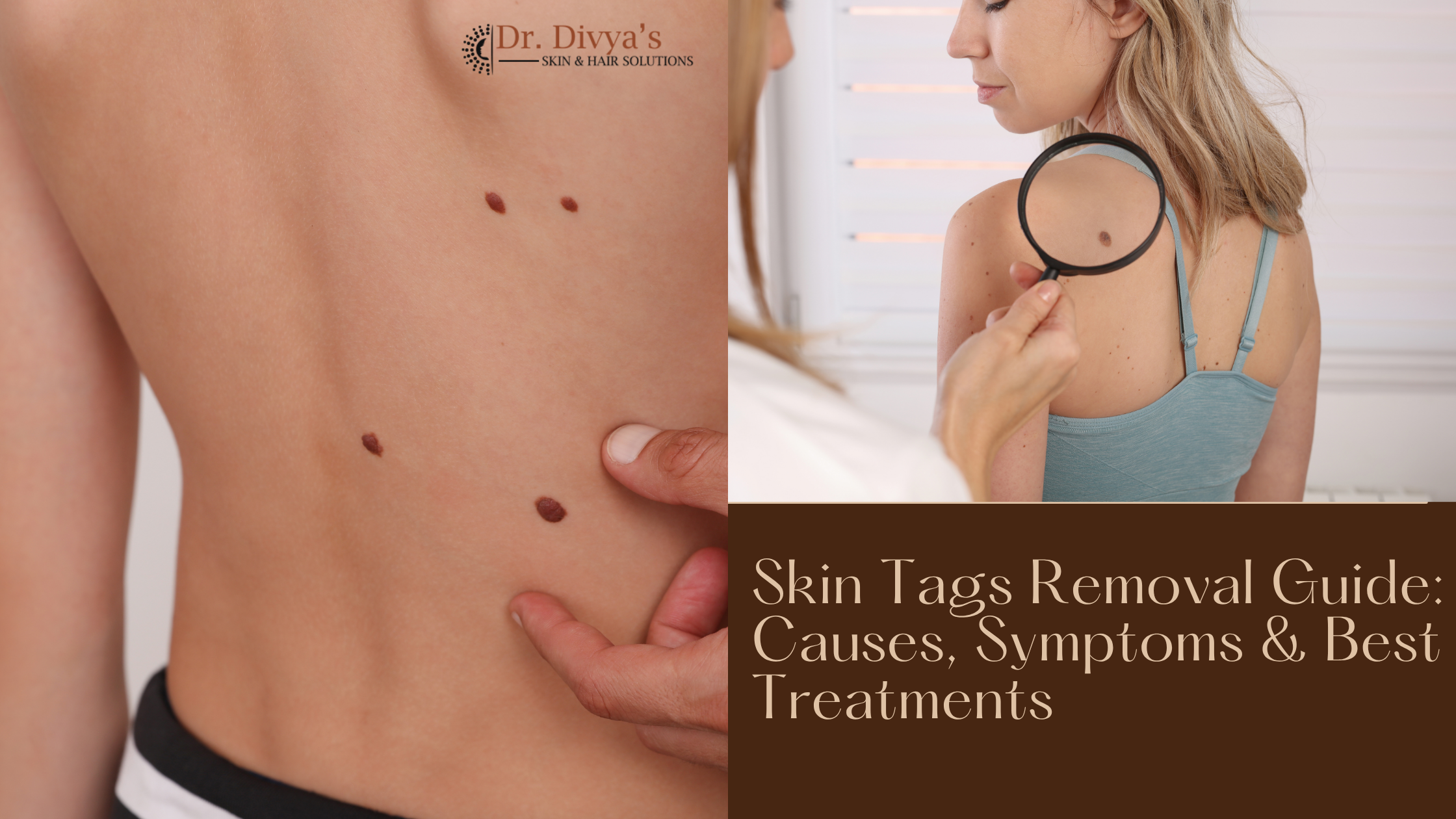 Skin Tags Removal Guide