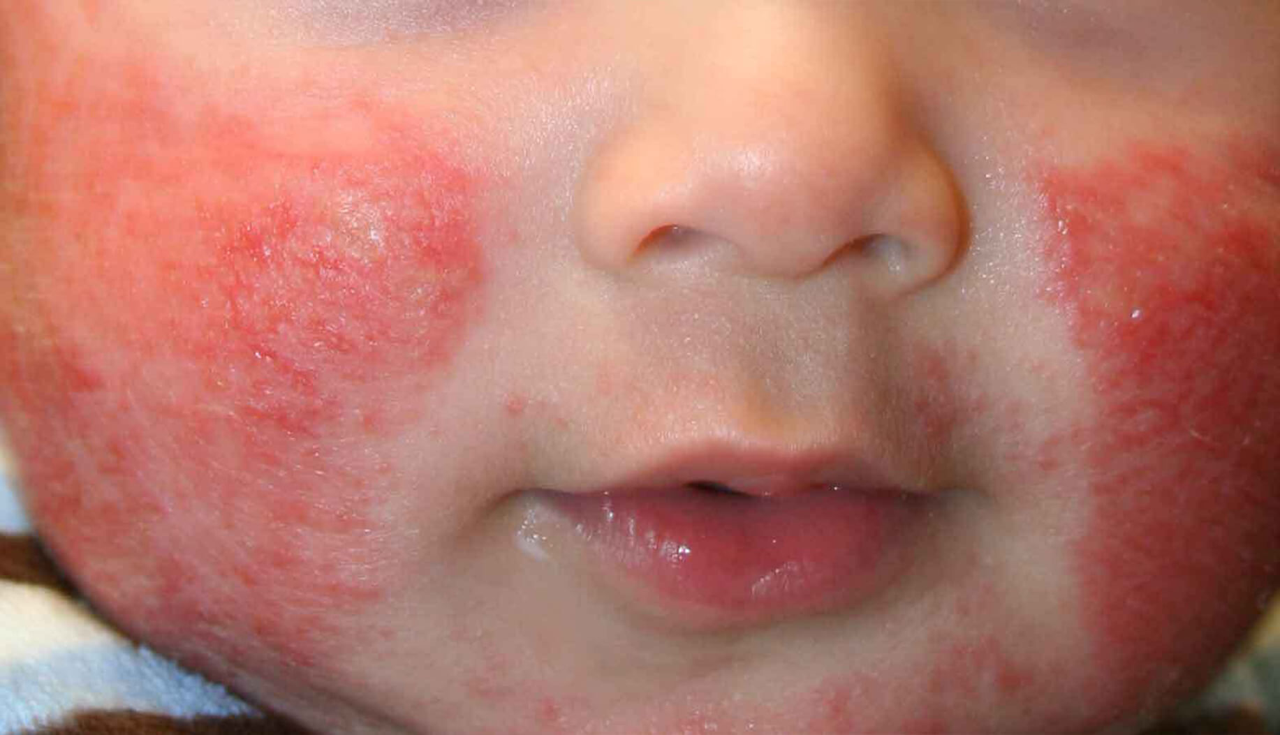 cashew allergy skin rash babies