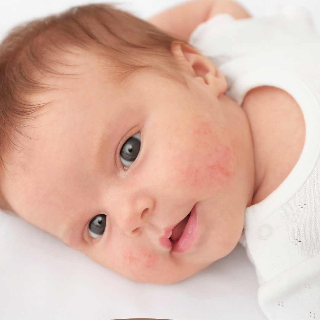 When to take your child to a pediatric dermatologist?