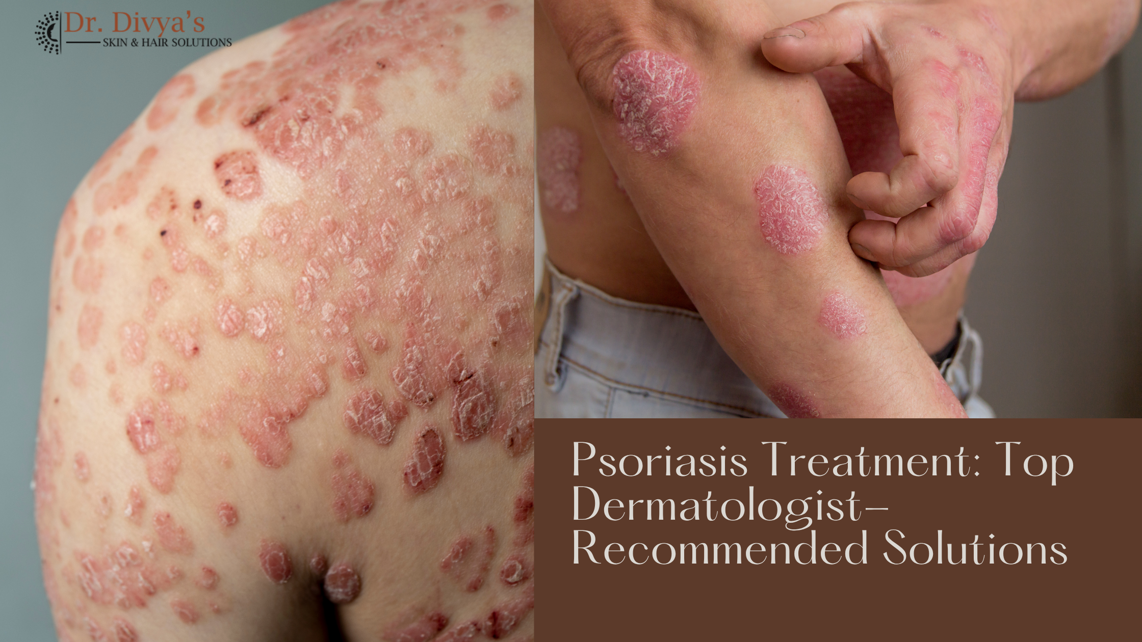 Psoriasis Treatment