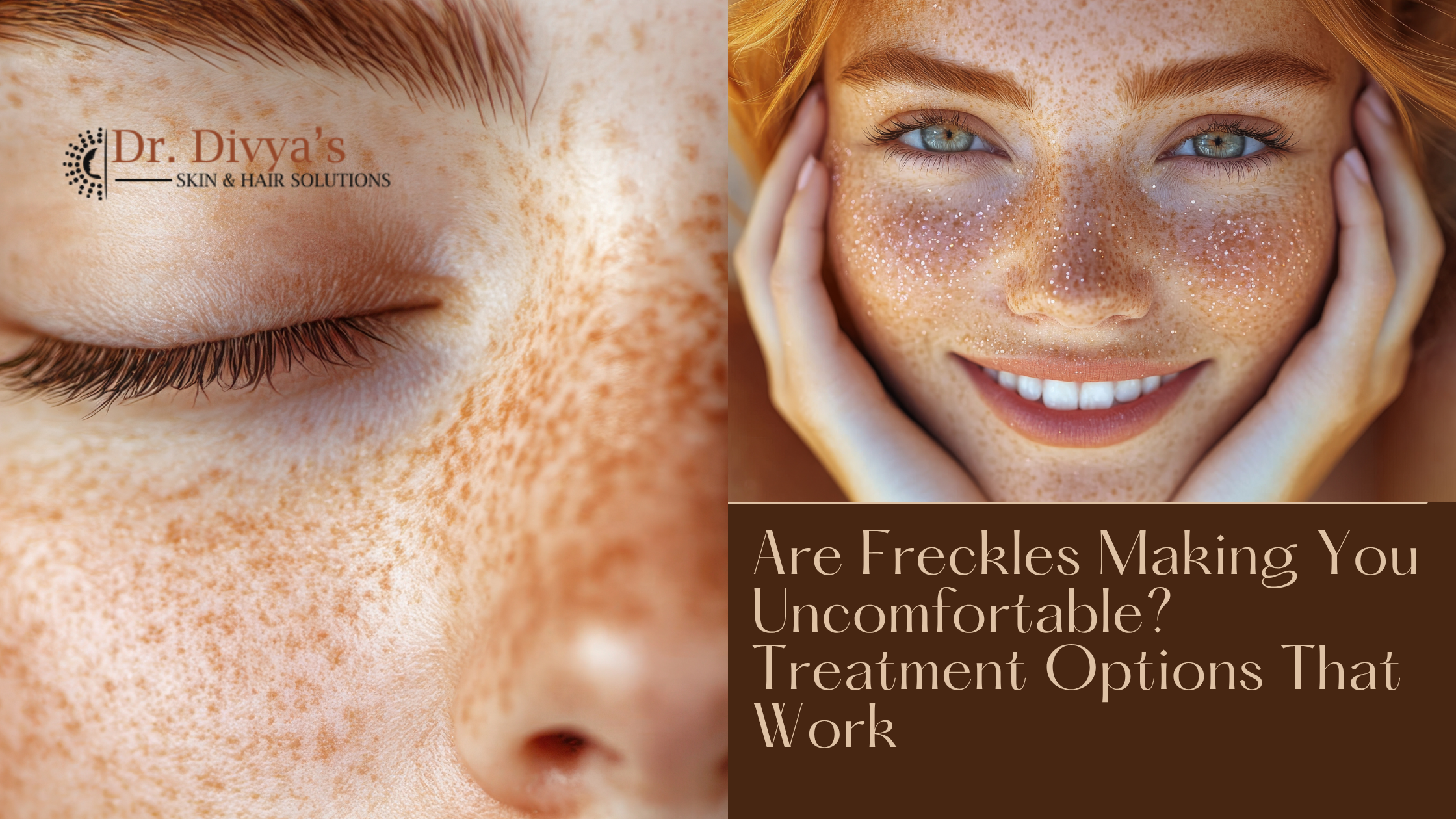 Are Freckles Making You Uncomfortable