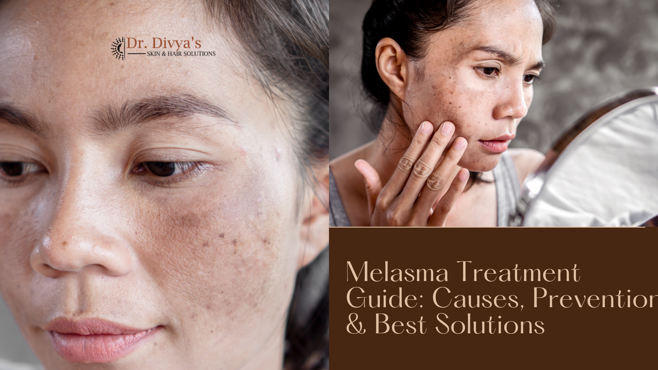 Melasma Treatment Guide