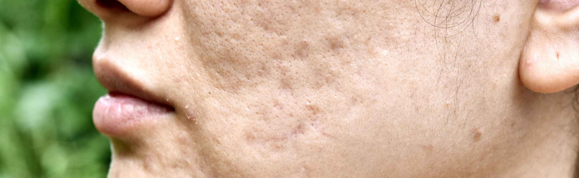 Acne Scar treatment in banagalore