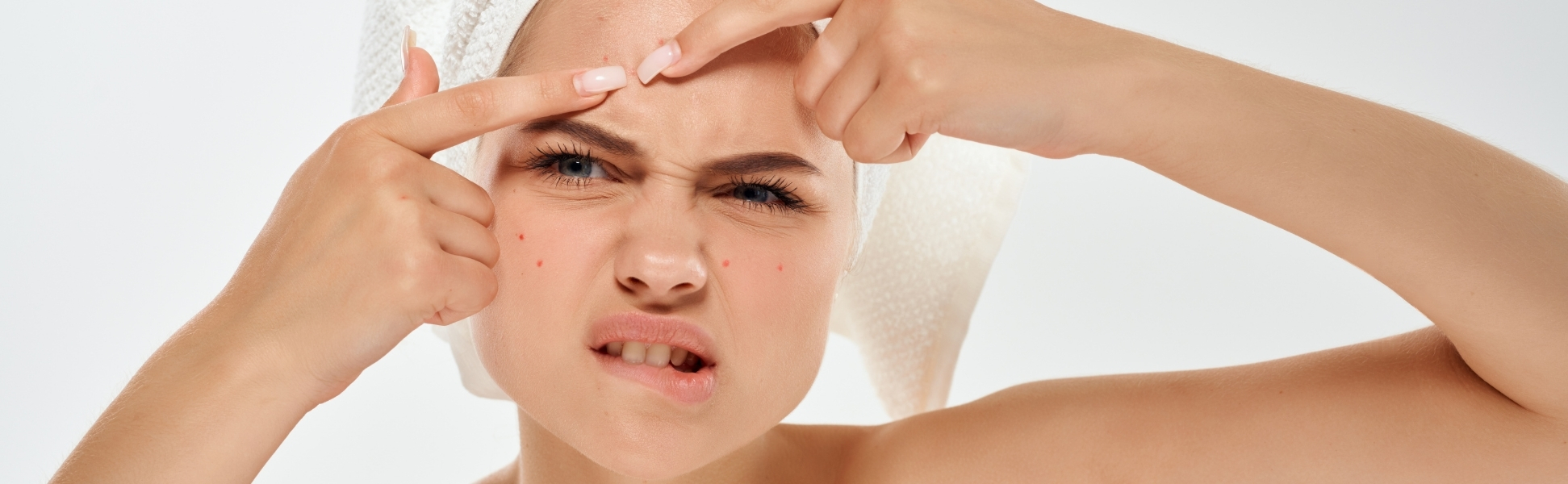 remedies for pimple