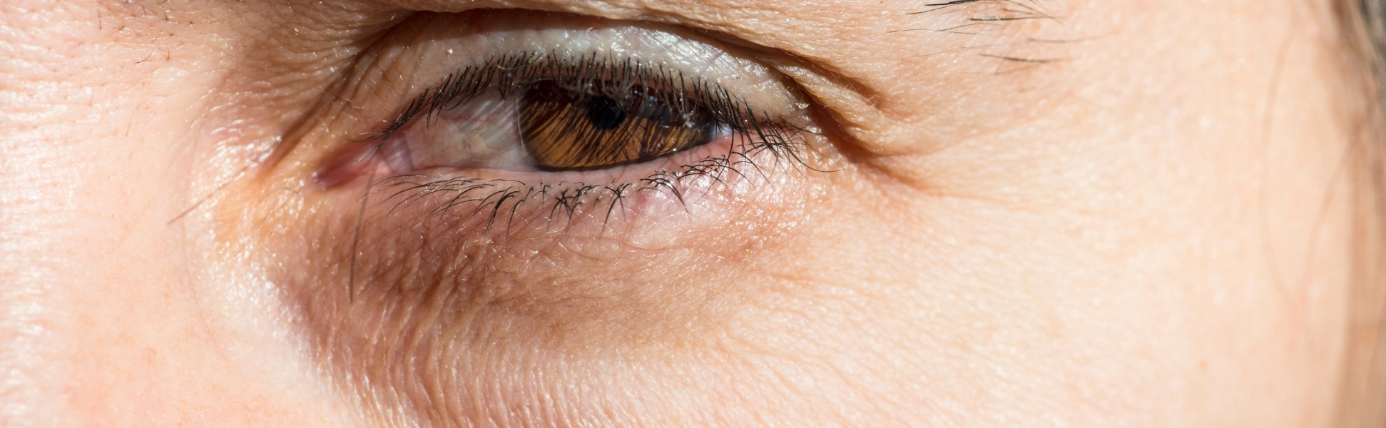 causes of under eye hollowness