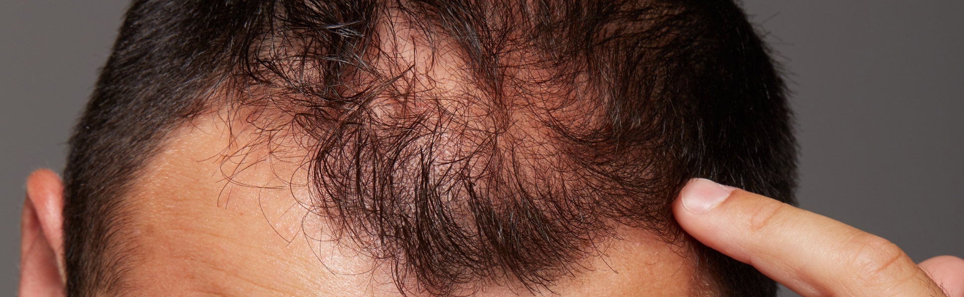 Treatment for scarring alopecia