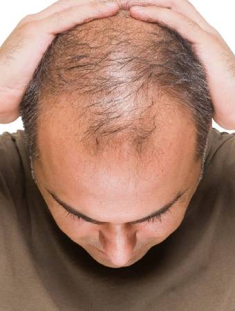Hair Loss in Men