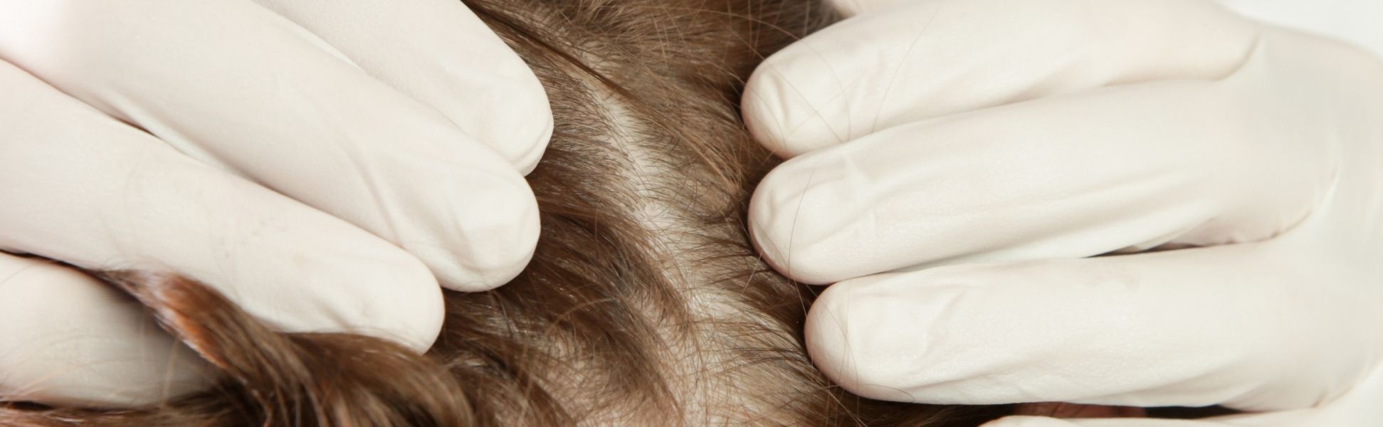 Scalp Infection treatment in Bangalore