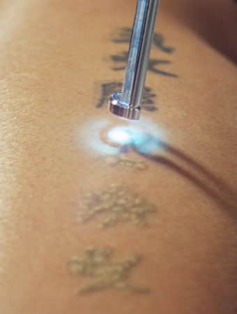 Tattoo Removal Treatment in Bangalore