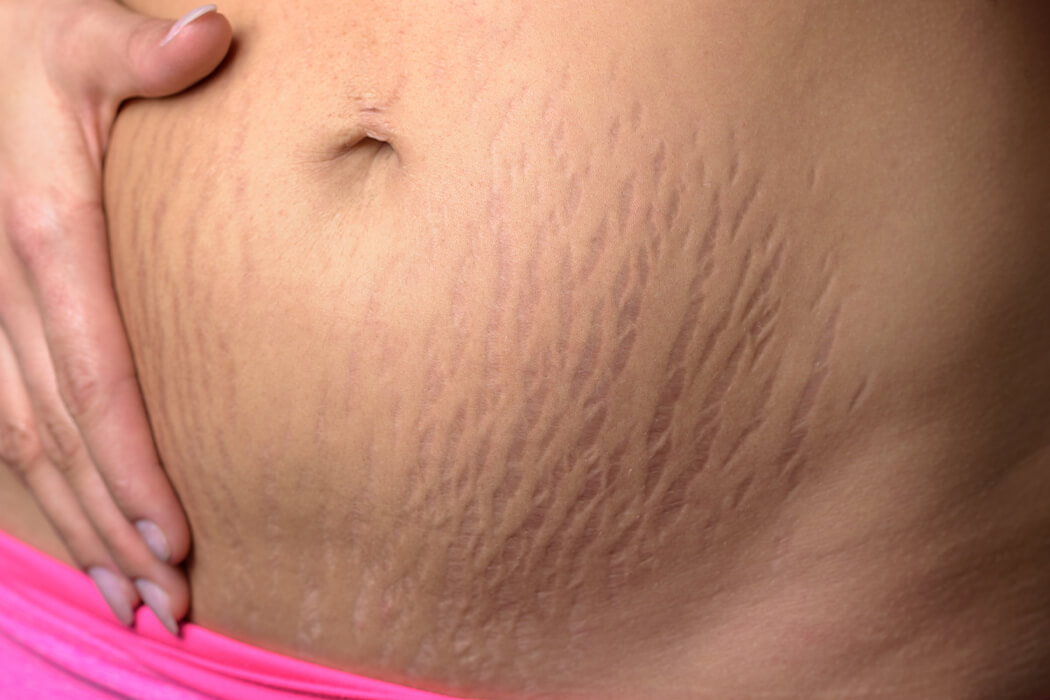 Stretch Marks Removal in Bangalore