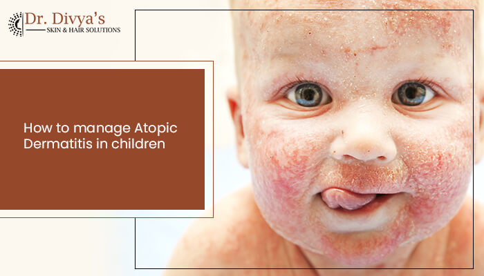 how to manage atopic dermatitis in children